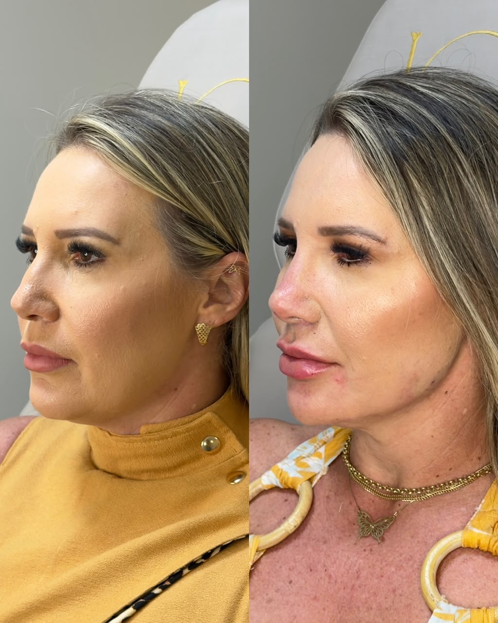 Resultado antes e depois