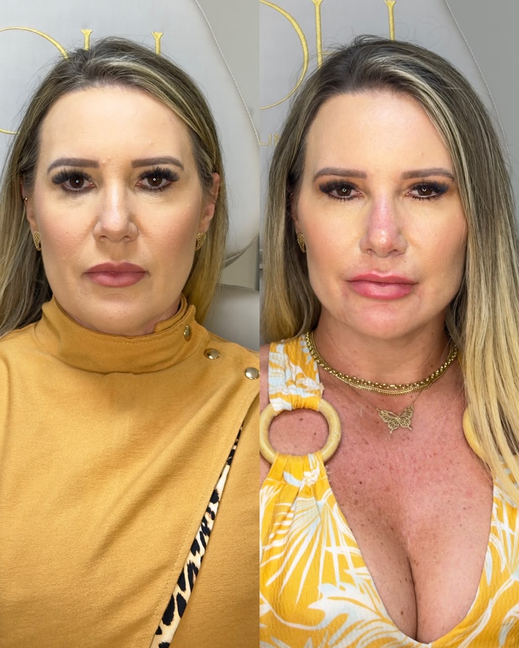 Resultado antes e depois