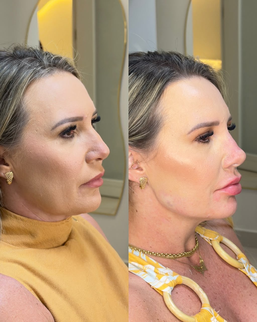 Resultado antes e depois